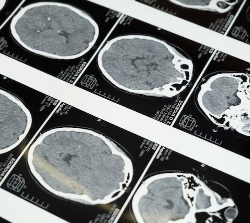 When to See a Doctor After Head Trauma from a Car Accident